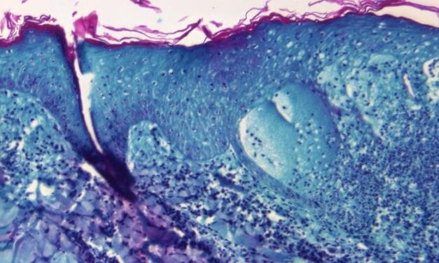 SE REGISTRAN MÁS DE 3 MIL CASOS DE VIRUELA DEL MONO EN 40 PAÍSES
