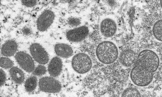 SE REGISTRA EN IMPERIAL EL PRIMER CASO DE VIRUELA DEL MONO